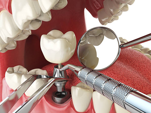 Best Emergency Wisdom Teeth Removal in Montclair, VA
